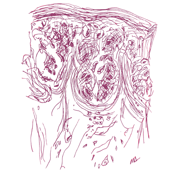 melanoma